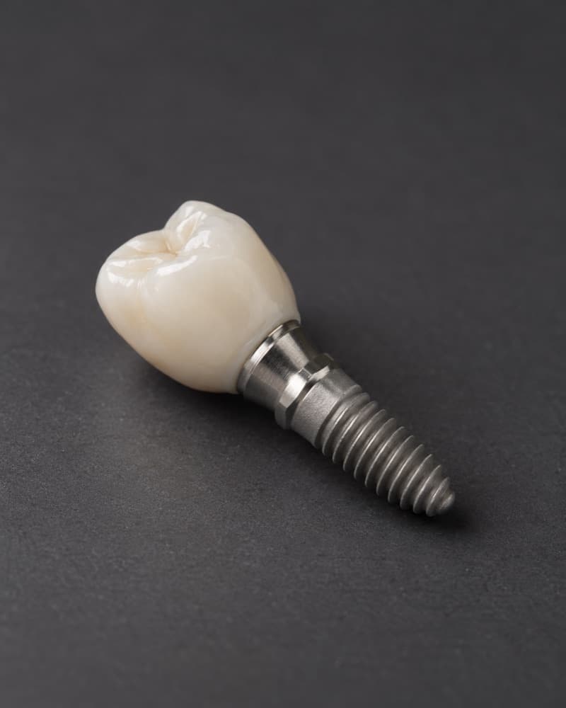 Un poste de implante dental con una corona de cerámica