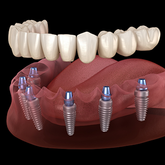Illustration of a full denture being secured onto six dental implants throughout the arch