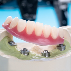 Model of an implant denture in a dental lab