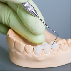 Model of a row of teeth with a dental bridge covering three consecutive teeth