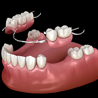 Illustration of a partial denture replacing several teeth along an arch