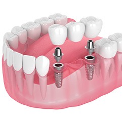Illustration of an implant bridge