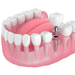 Illustration of a dental implant with a dental crown