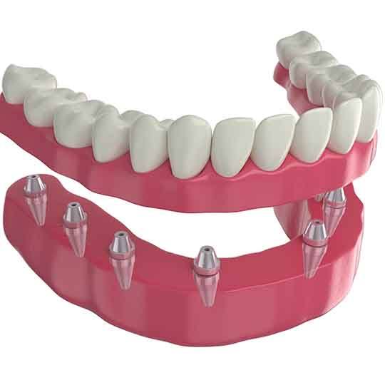 implant dentures combine the convenience of dentures with the stability of dental implants