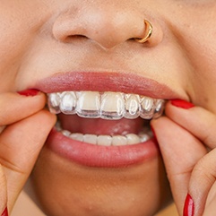 Closeup of woman placing Invisalign over upper arch