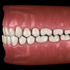 Illustration of an underbite
