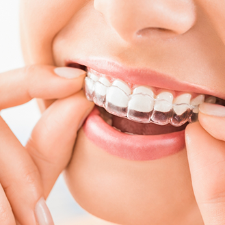 Close up of a person placing an Invisalign clear aligner over their teeth