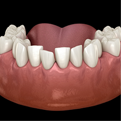 Illustration of a mouth with crowded lower teeth