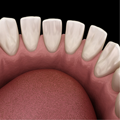 Illustration of a mouth with gapped lower teeth