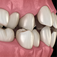 Illustration of a mouth with misaligned upper and lower arches of teeth