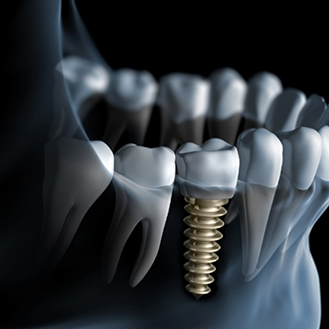 Illustration of a lower jaw with a dental implant replacing a missing tooth