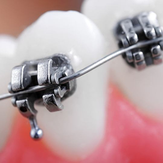 Close up of a row of teeth with traditional braces