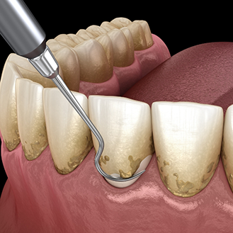 Illustration of a dental scaler clearing tartar buildup from the gumline