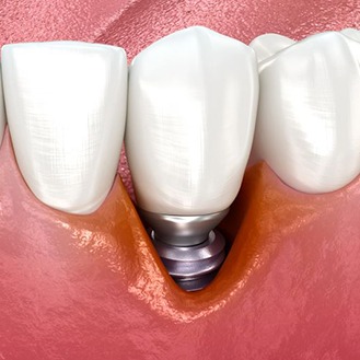 Illustration showing infected tissue around a dental implant