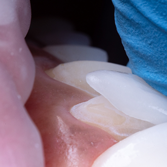 CLose up of a veneer being bonded to a tooth