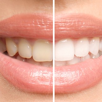 In-office teeth whitening treatment