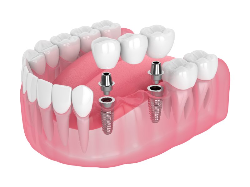 Exploded illustration of implant bridge