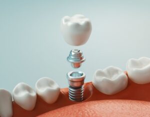 Animated model of dental implant.