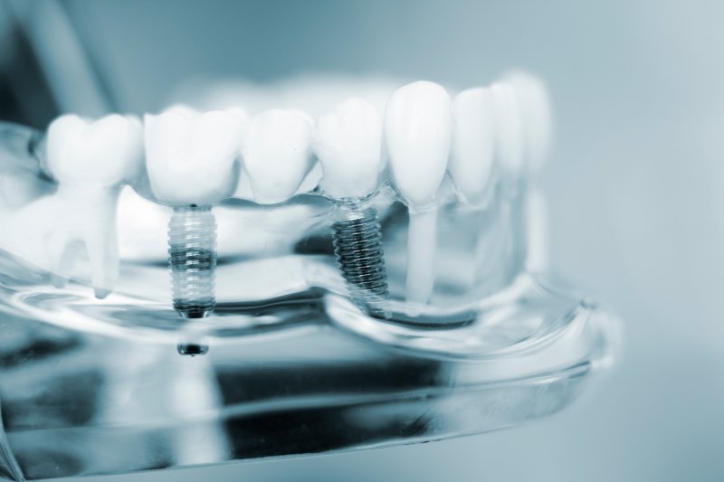 a model of dental implants in a glass jawbone