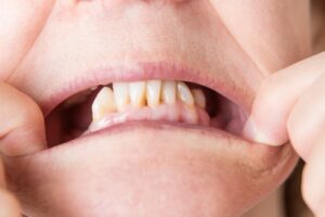 Mouth with missing back teeth.