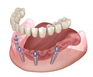 Rendering of implant dentures. 