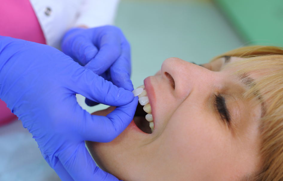 Patient being fitted with veneers